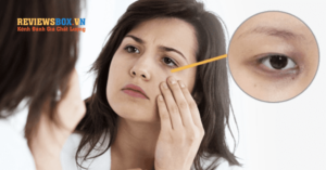 Quầng Thâm Mắt Và Cách Trị Hiệu Quả
